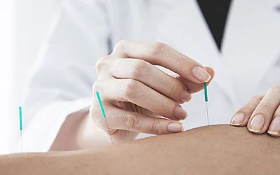 Acupunctură
